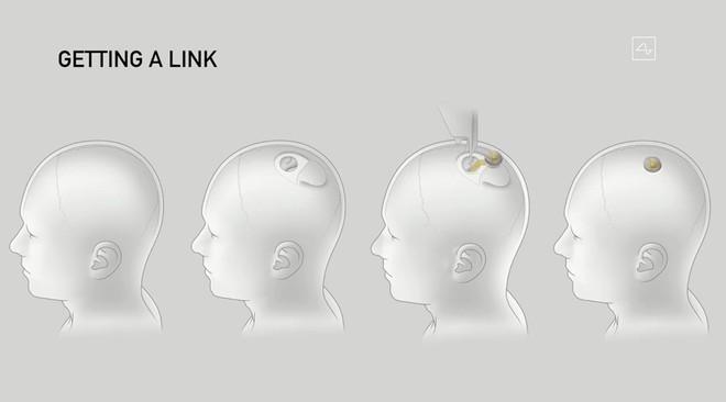 Neuralink, installazione